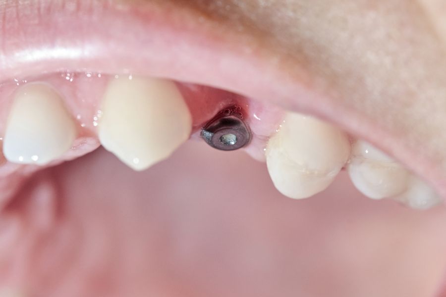 Czym jest implantologia zębowa? Poradnik dla seniorów